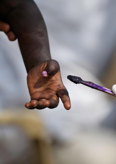 Marking a vaccinated child's finger with gentian violet during a measles vaccination campaign (vaccinated nearly 14,500 children) in Doro refugee camp.
