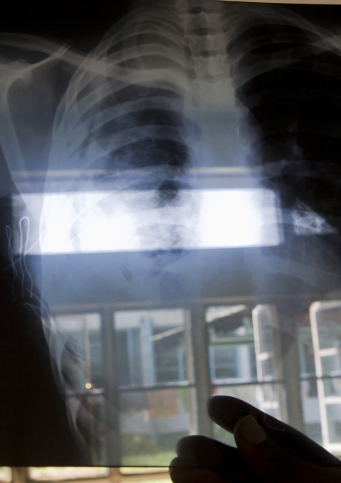 Clinical officer Nicholas Oucho examines Lillians old chest xray. The new one will tell him how her tretament is progressing.  In Nyanza Province in Kenya, the prevalence of AIDS has reached 35%. In Homa Bay, a town on the shores of Lake Victoria, with a population between 50 and 70 000, MSF has about 10 000 patients following ARV treatment, among them are 1053 children.