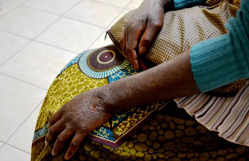 Angelina* is one of the 11% of people in Mozambique who are living with HIV; she also suffers from Kaposi’s Sarcoma, a type of cancer related to her condition, that causes painful and disfiguring lesions on the skin. Angelina sometimes develops wounds on her skin caused by infections secondary to HIV. “It’s happened that I scratch them until I can see the new skin below,” she says. “The skin goes up into the air like dust.” *Name has been changed