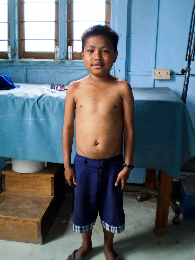 Same child, 6 months later in MSF's Singngat clinic in Manipur, 2010 India.