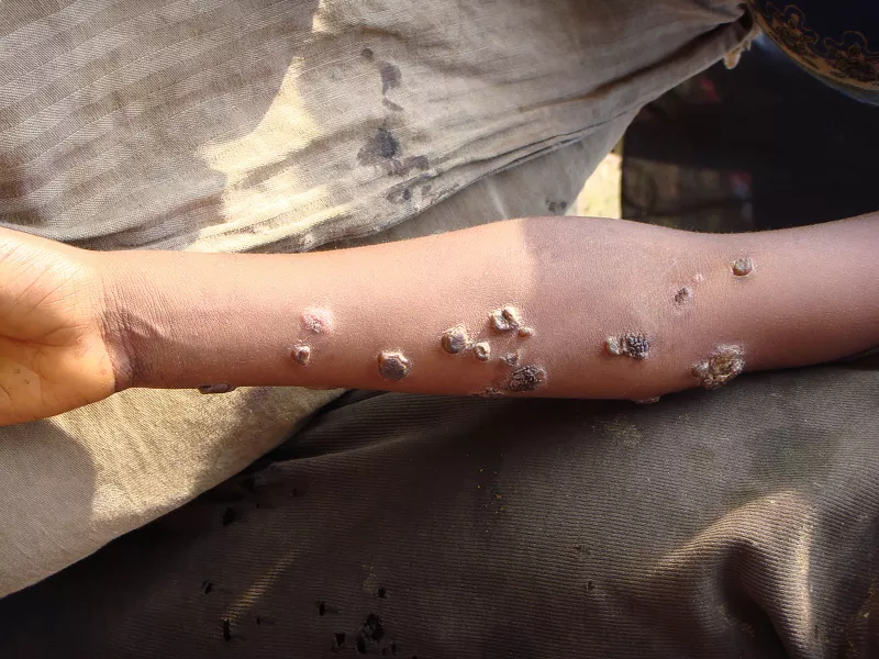 Yaws is a neglected tropical disease caused by a bacterium that affects the skin, bone and cartilage.