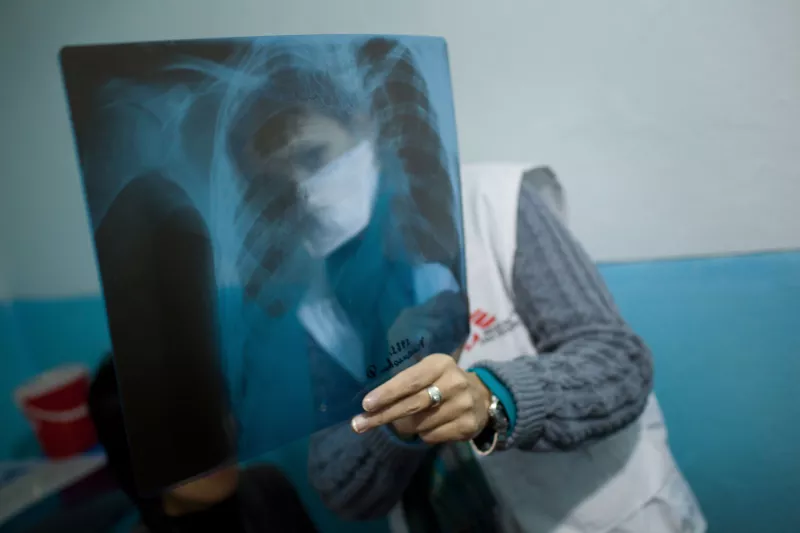 Natalia, a MSF doctors show its lung x-ray to a XDR TB patient in Kara Suu hospital.