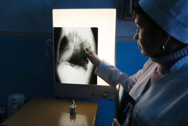 A Ministry of Health nurse inspects an x-ray scan of the lungs of one patient who is supported by MSF, at the Artyomovsk TB dispensary outside Donetsk. 