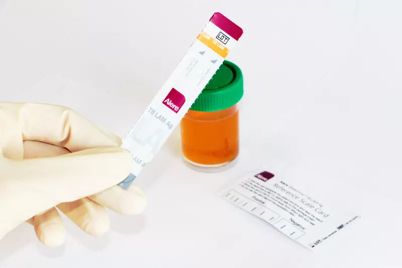 TB-LAM tests  Tuberculosis is the biggest killer of people living with advanced HIV, with over 400,000 patients dying each year from the disease. People with advanced HIV, also known as Acquired Immune Deficiency Syndrome (AIDS) have very weakened immune systems, leaving them susceptible to common infections like TB, which can quickly become deadly. Photograph by Sean Cleere