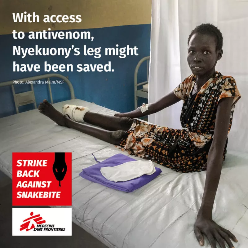 With Access to Antivenom With Snakebite Treatment Nyekuony Leg Might be Saved