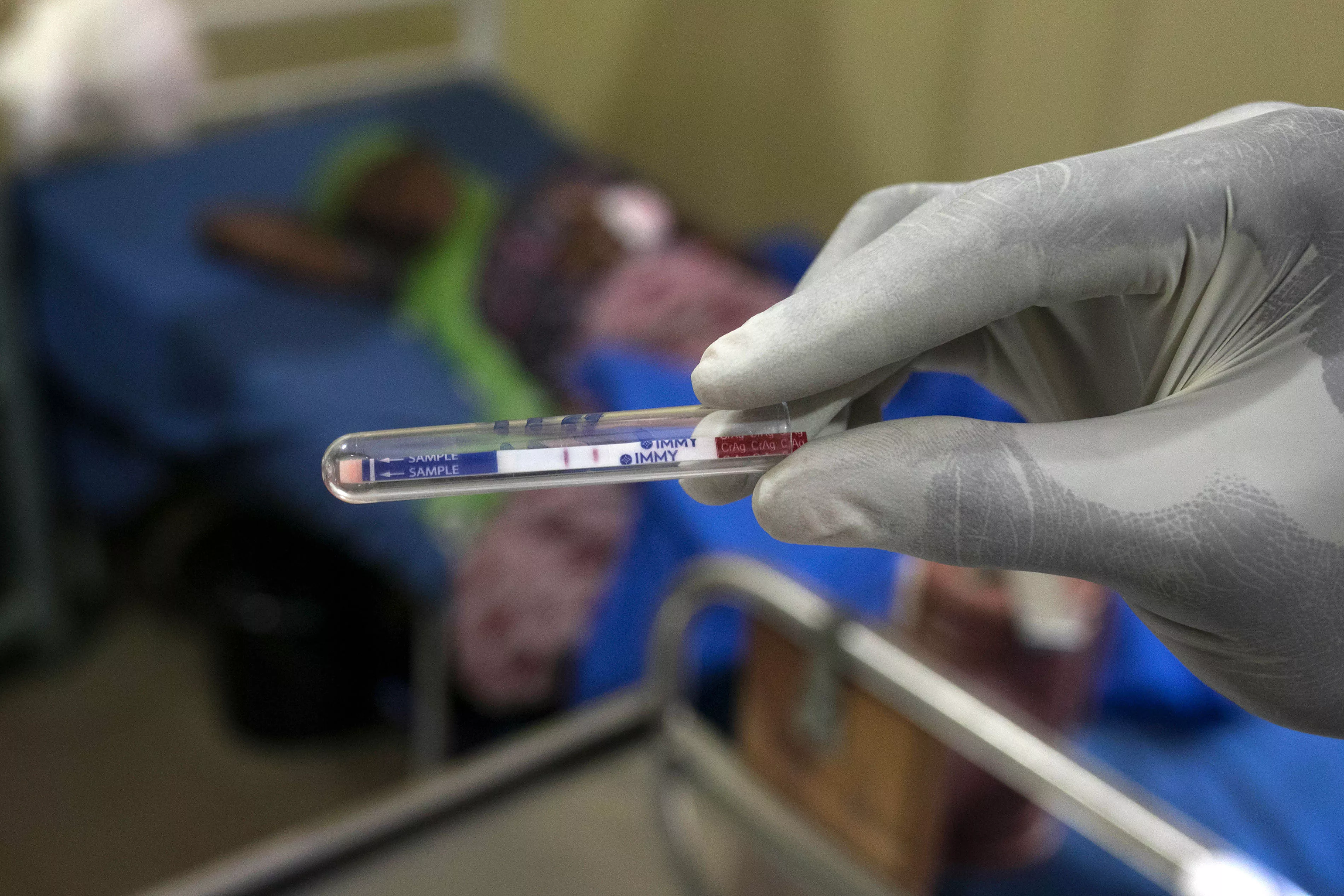 An MSF nurse performs a Cryptococcal Antigen (CrAg) screening test to test for Cryptococcal Meningitis in an AIDS patient.