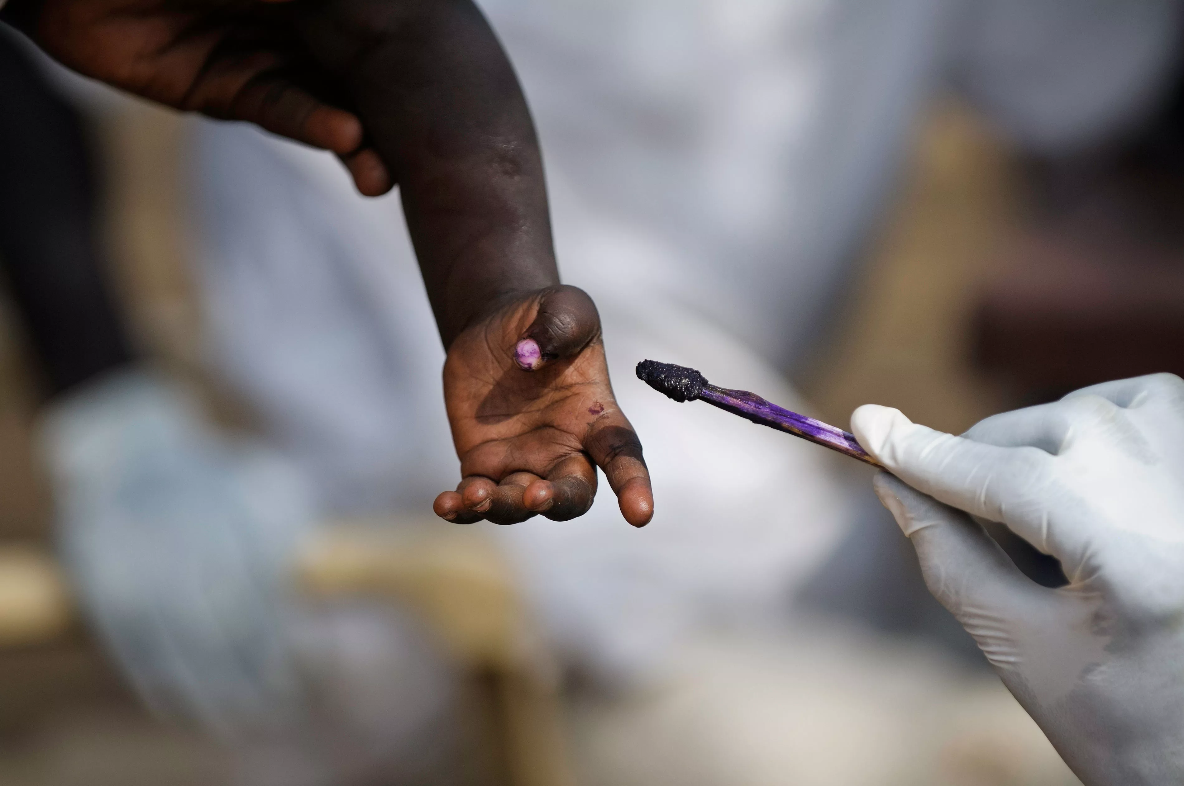 Marking a vaccinated child's finger with gentian violet during a measles vaccination campaign (vaccinated nearly 14,500 children) in Doro refugee camp.