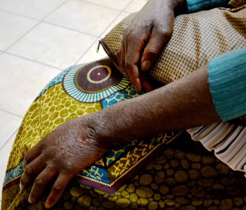 Angelina* is one of the 11% of people in Mozambique who are living with HIV; she also suffers from Kaposi’s Sarcoma, a type of cancer related to her condition, that causes painful and disfiguring lesions on the skin. Angelina sometimes develops wounds on her skin caused by infections secondary to HIV. “It’s happened that I scratch them until I can see the new skin below,” she says. “The skin goes up into the air like dust.” *Name has been changed