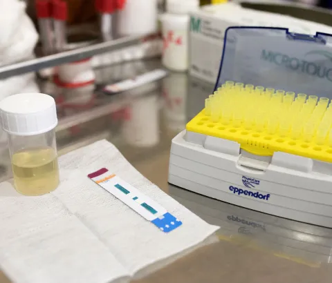An MSF nurse performs a TB LAM test using a patients’ urine to test the presence of TB in a severely ill AIDS patient.