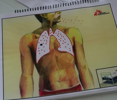 Treatment options for patients with drug-resistant TB remain far short of what is needed. Treatments are long (up to 2 years), toxic (serious side-effects) and expensive. 